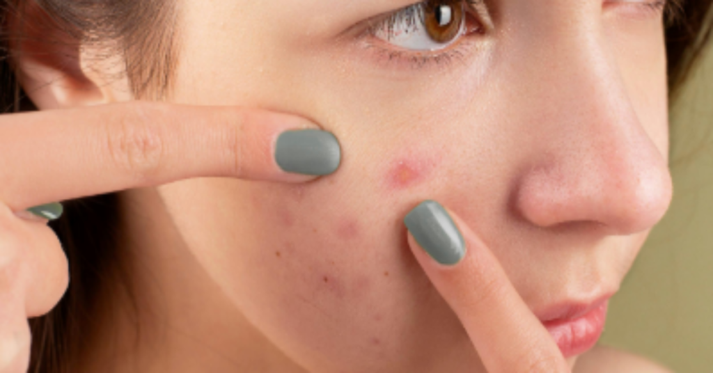 apa itu jerawat dan penyebabnya