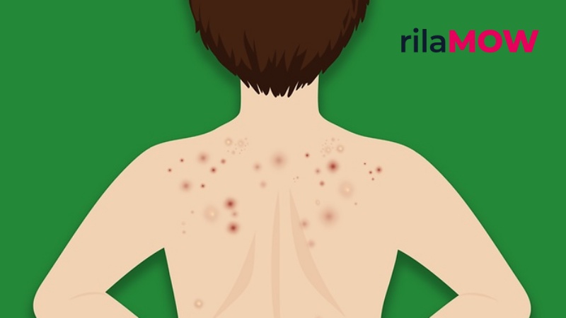 Sabun mandi salicylic acid terbaik 2026 untuk jerawat badan di punggung dan dada